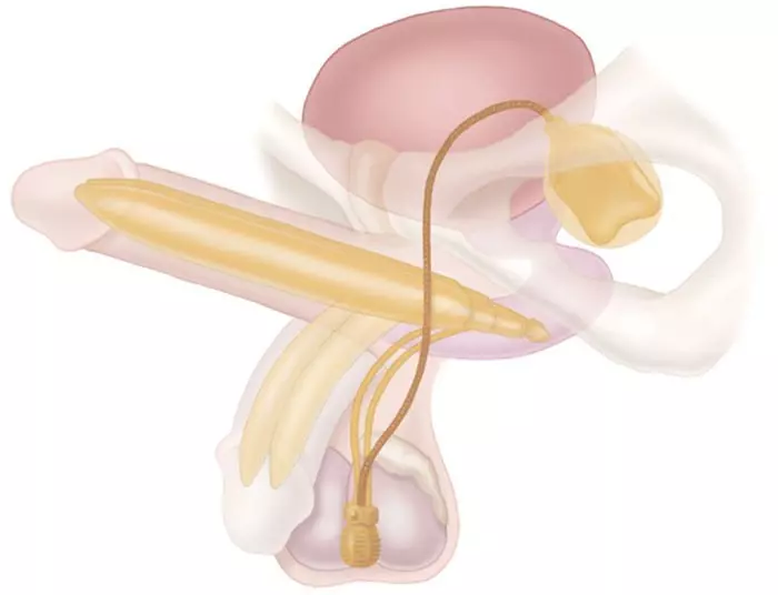 أهمية جراحة زرع القضيب: دليل شامل لعملية الدعامة الذكرية