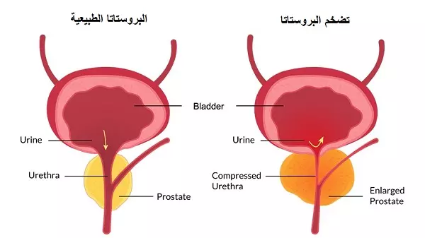 تضخم البروستاتا : الأعراض والتشخيص والتدابير الاحترازية